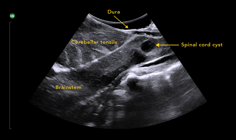 Chiari-01