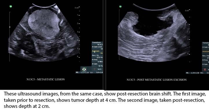 Unsgard_US_Clinical_Pre_Post_Resection_v2