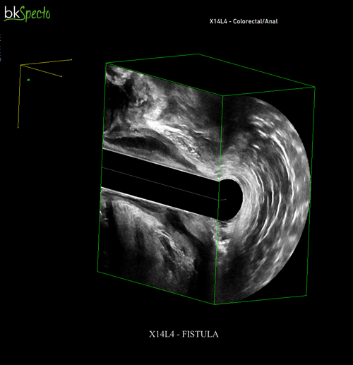 X14L4_fistula 